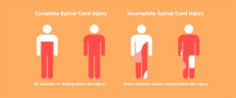 spinal cord injury incomplete vs complete